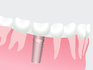 インプラント